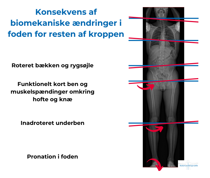 Konsekvens af biomekaniske ændringer i foden for resten af kroppen